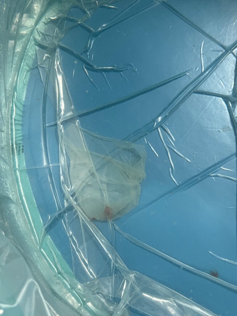 My Birth Story - My amniotic sac in the birth pool after it fell out of me